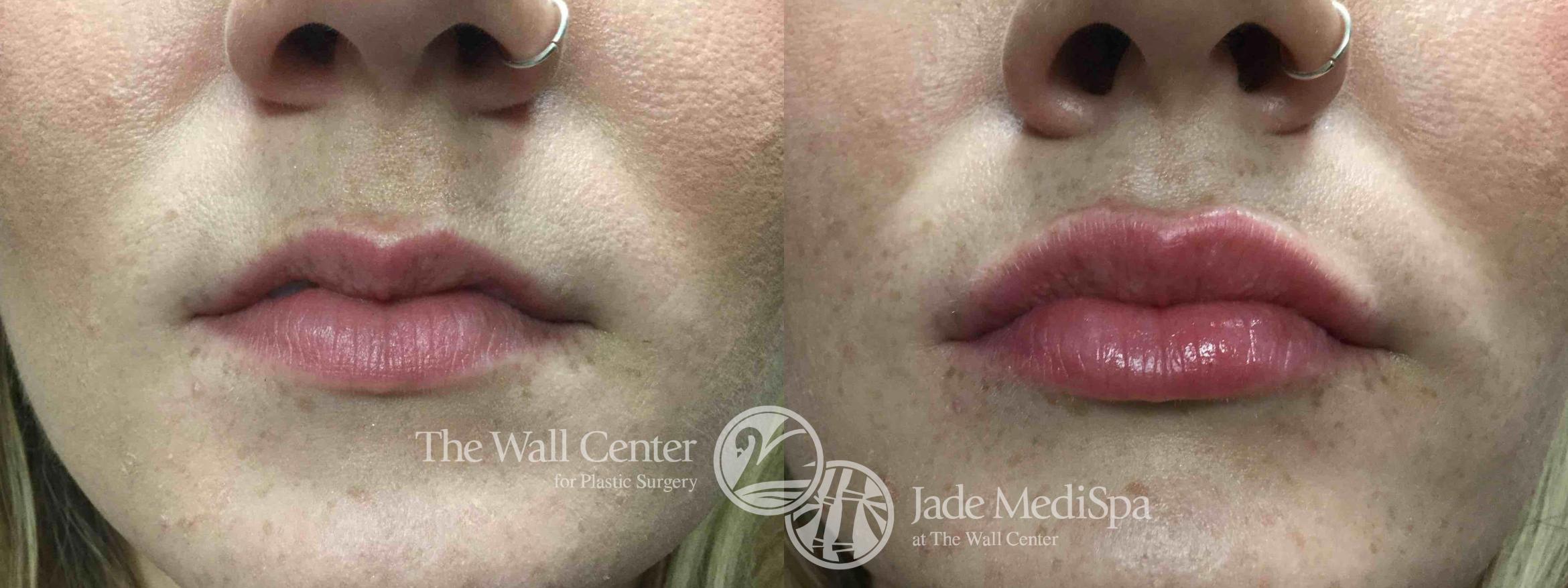 Before & After Lip Augmentation Case 746 VIEW #1 View in Shreveport, LA