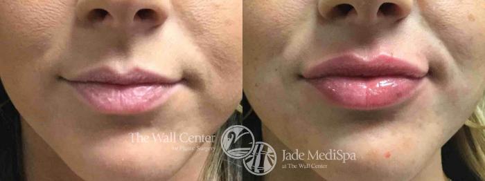 Before & After Lip Augmentation Case 747 VIEW #1 View in Shreveport, LA