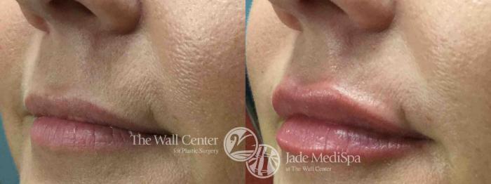 Before & After Lip Augmentation Case 748 VIEW #1 View in Shreveport, LA