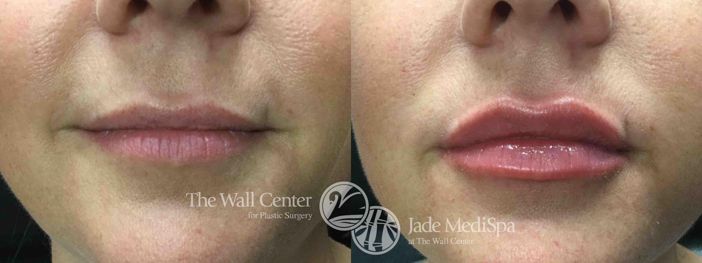 Before & After Dermal Fillers Case 748 VIEW #2 View in Shreveport, LA