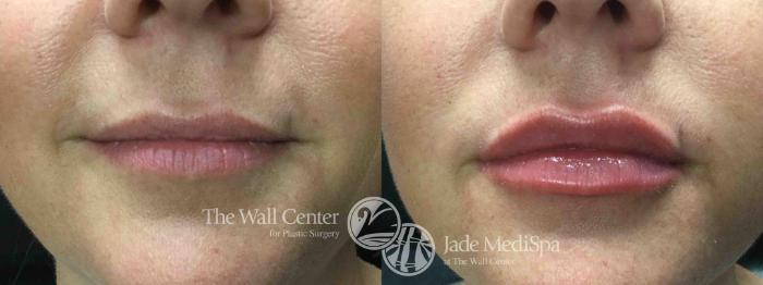 Before & After Lip Augmentation Case 748 VIEW #2 View in Shreveport, LA