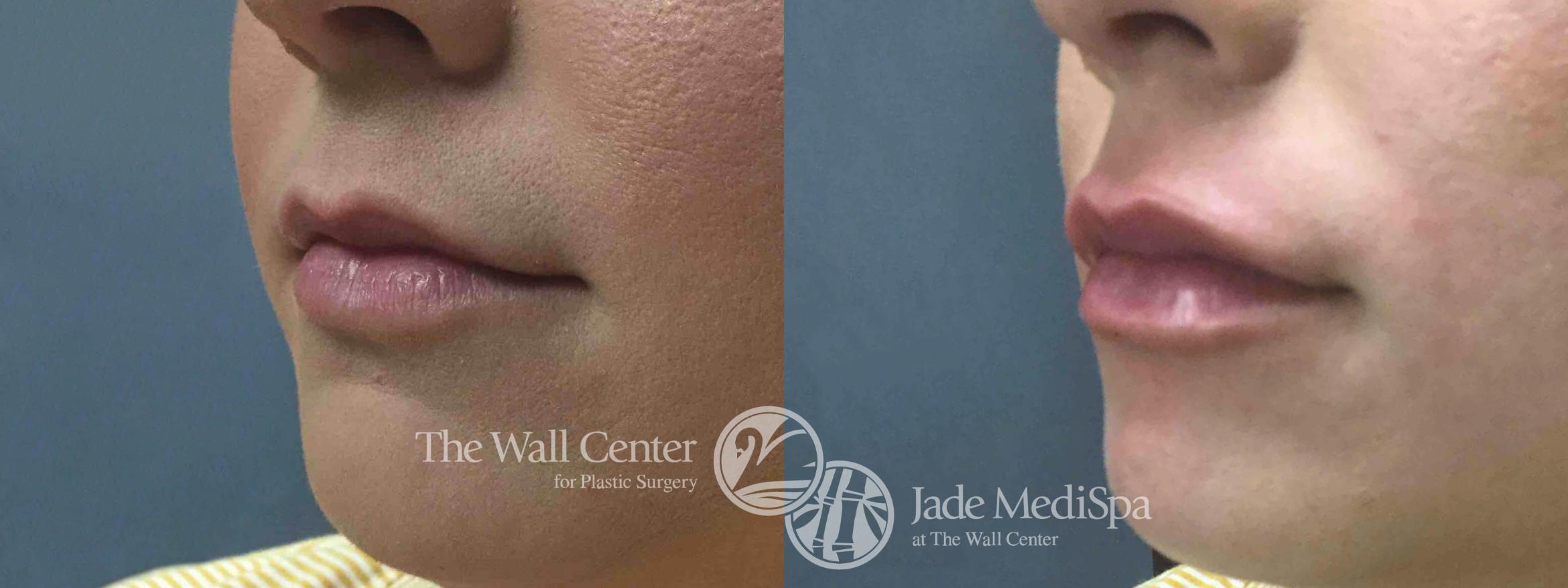 Dermal Fillers Case 749 Before & After VIEW #1 | Shreveport, LA | The Wall Center