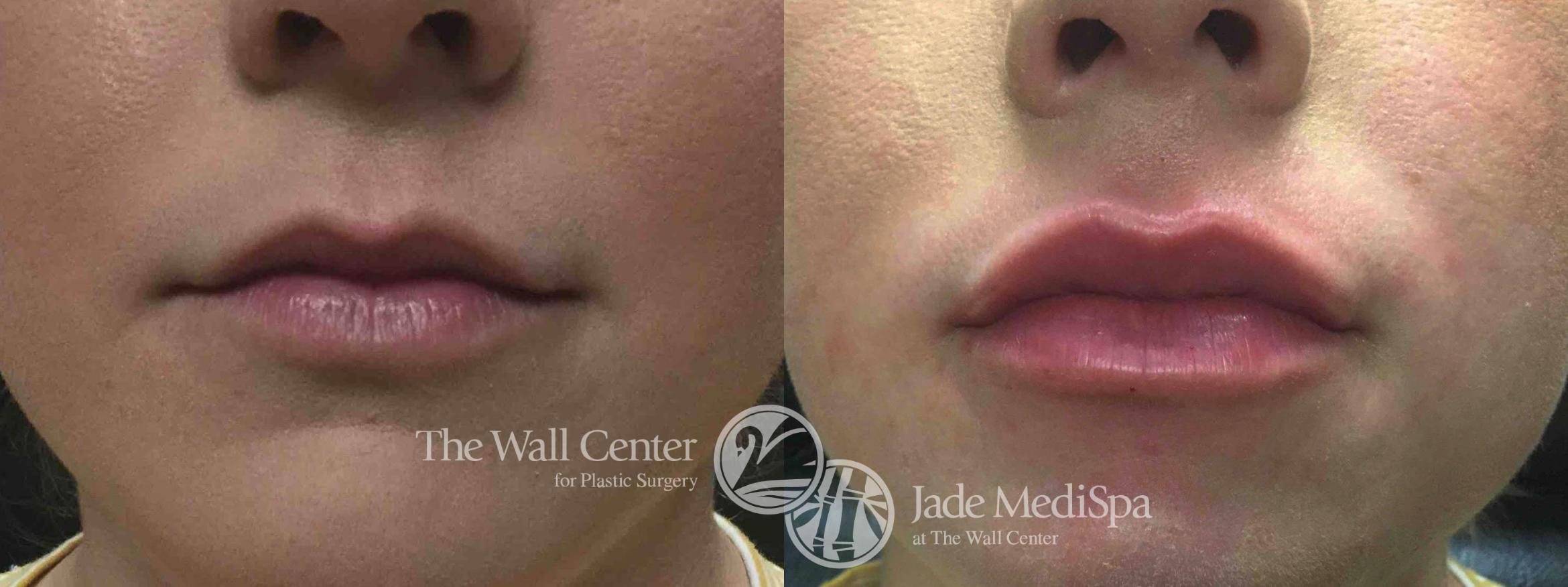 Dermal Fillers Case 749 Before & After VIEW #2 | Shreveport, LA | The Wall Center