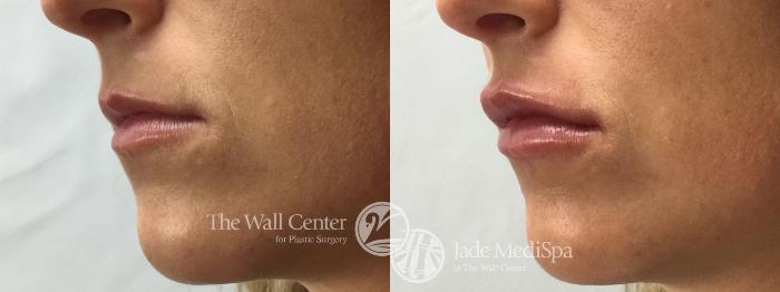 Before & After Lip Augmentation Case 751 VIEW #1 View in Shreveport, LA