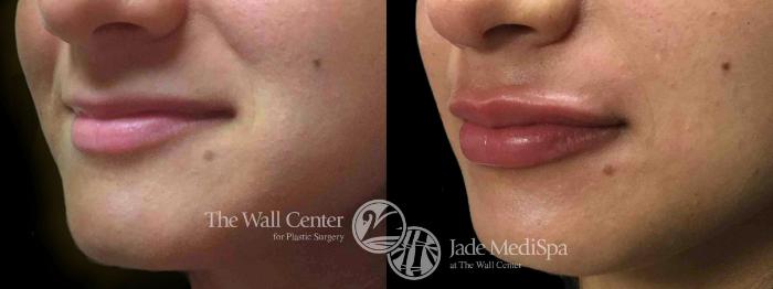 Before & After Lip Augmentation Case 753 VIEW #1 View in Shreveport, LA