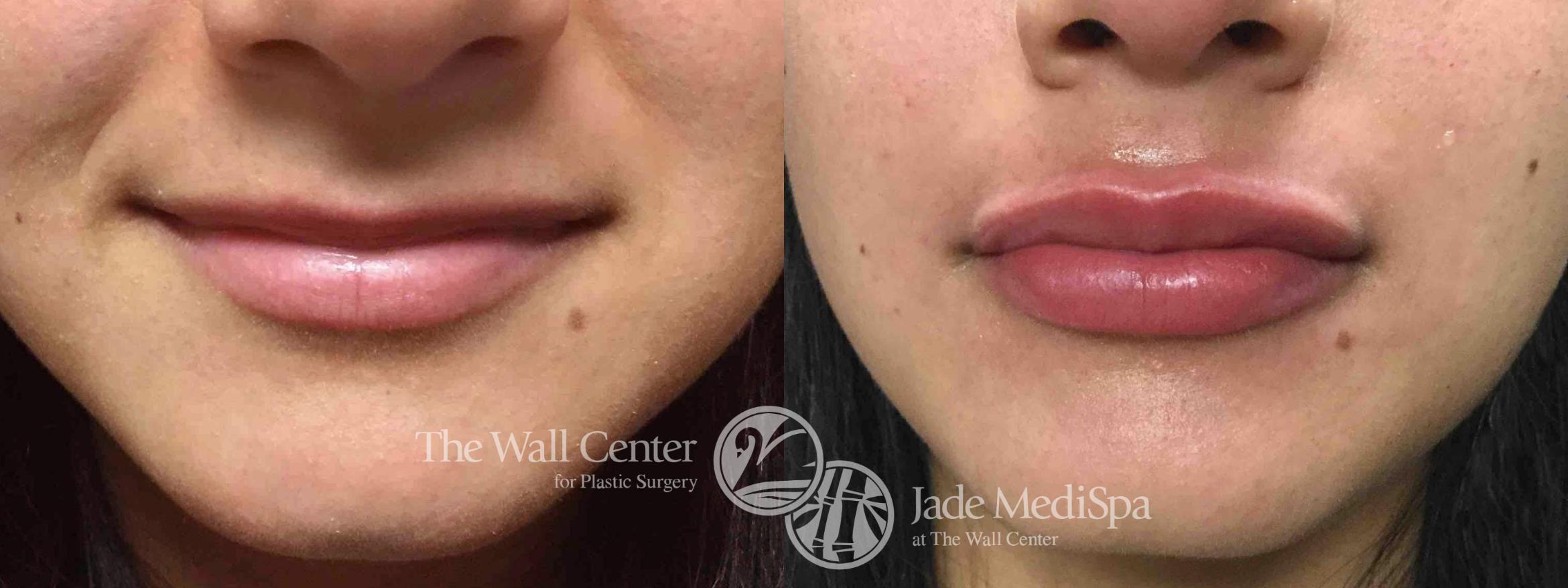 Before & After Dermal Fillers Case 753 VIEW #2 View in Shreveport, LA