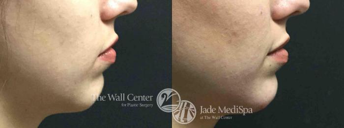 Before & After Cheek/Chin Augmentation Case 754 VIEW #1 View in Shreveport, LA