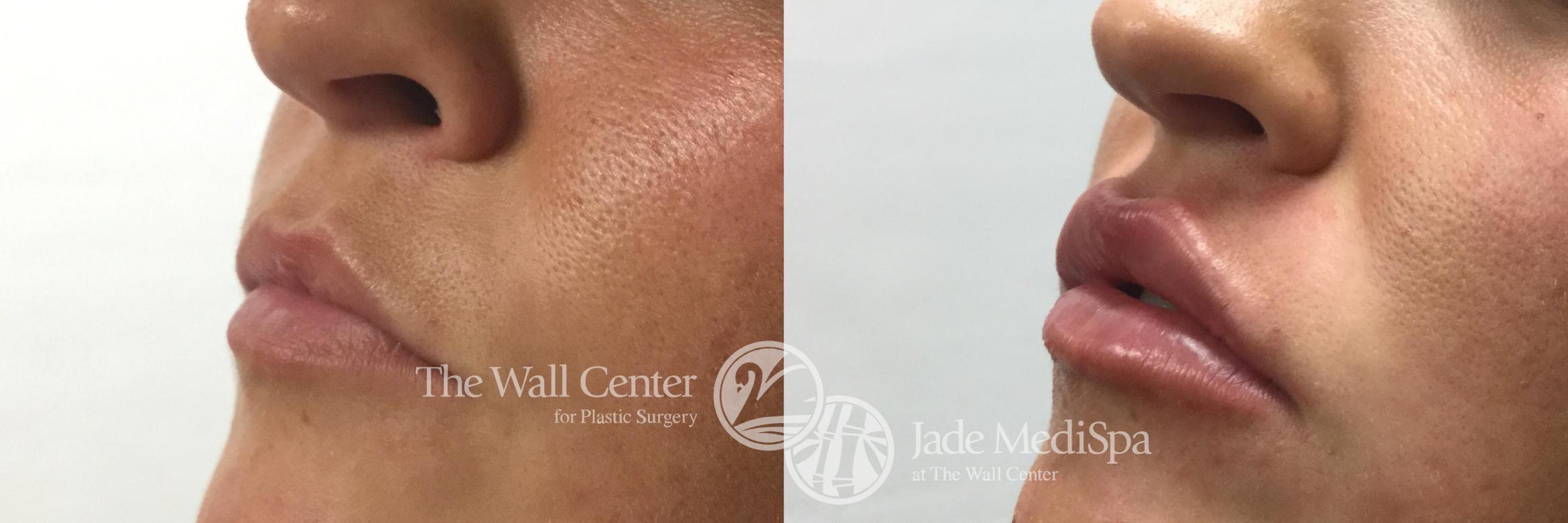 Dermal Fillers Case 755 Before & After VIEW #1 | Shreveport, LA | The Wall Center