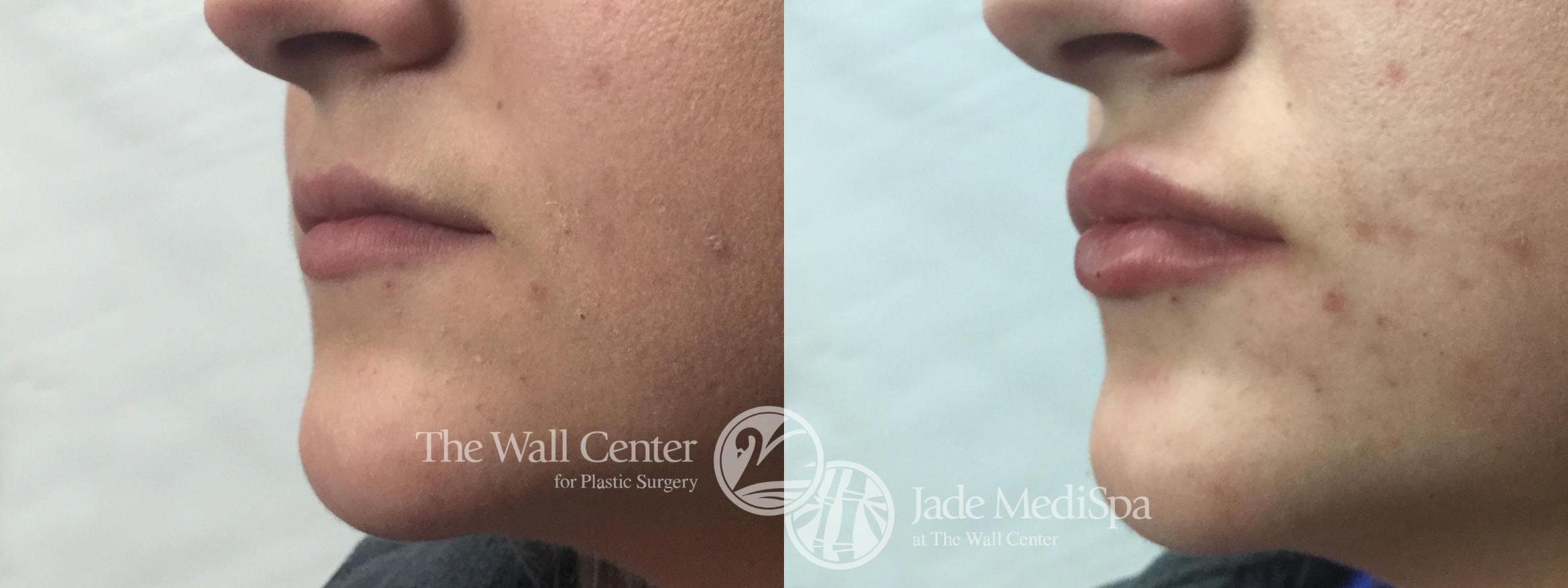 Dermal Fillers Case 757 Before & After VIEW #1 | Shreveport, LA | The Wall Center