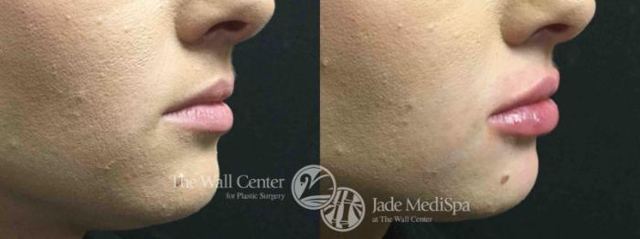 Before & After Lip Augmentation Case 759 VIEW #1 View in Shreveport, LA