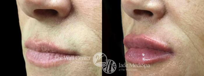 Before & After Lip Augmentation Case 760 VIEW #1 View in Shreveport, LA