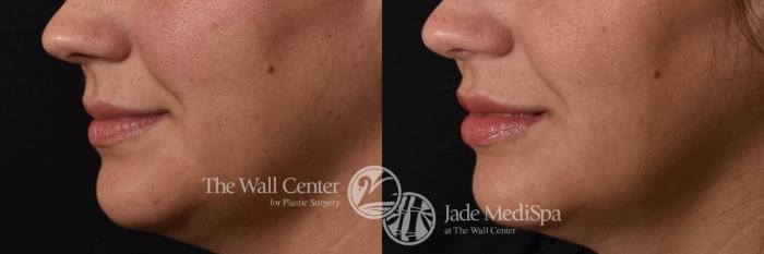 Before & After Lip Augmentation Case 786 VIEW #1 View in Shreveport, LA
