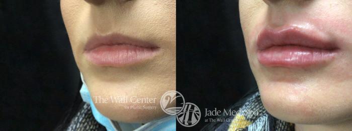 Lip Filler Left Oblique Photo, Shreveport, LA, Jade MediSpa, The Wall Center, Case 814