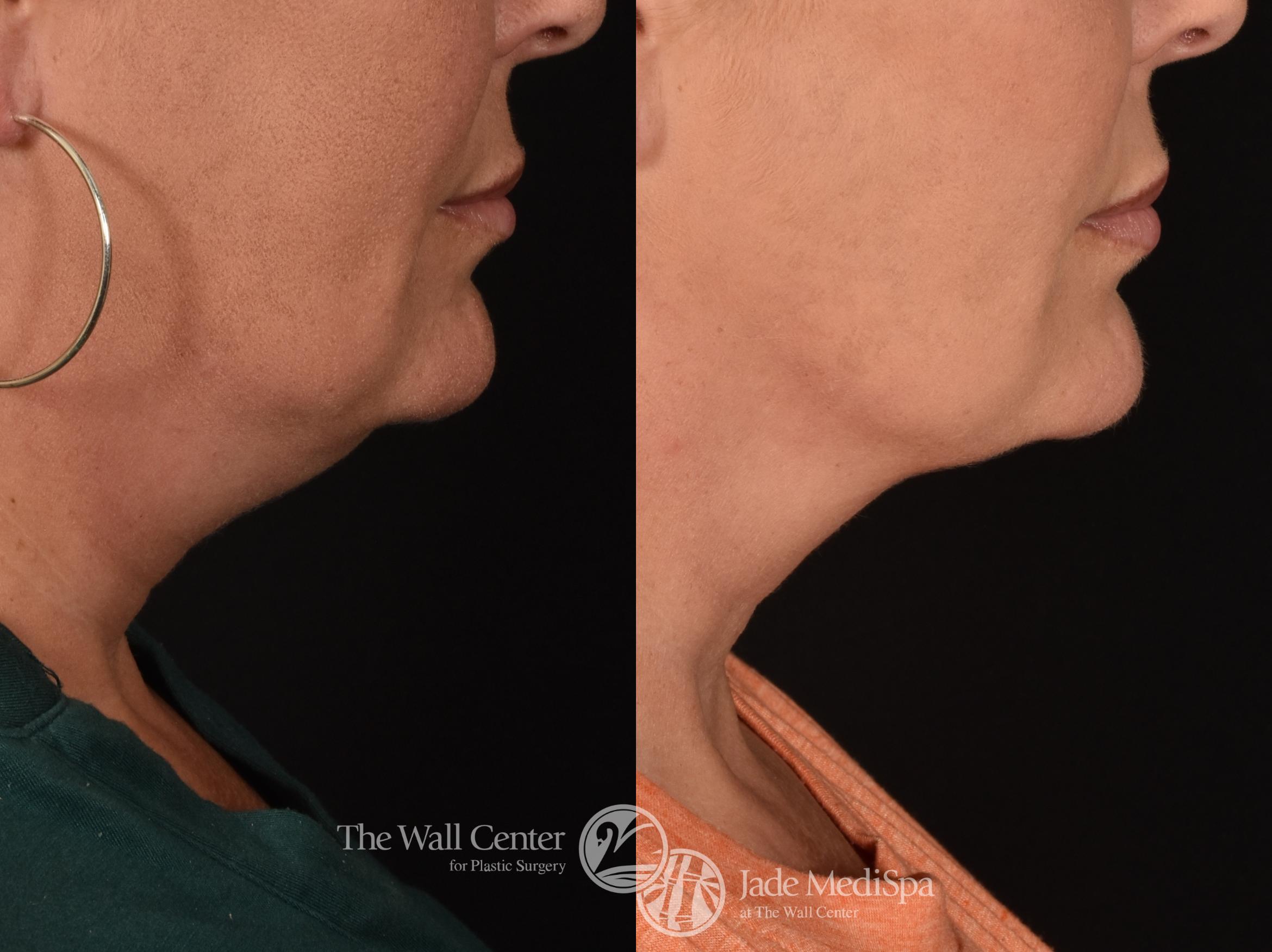 Before & After Double Chin Reduction Case 1158 Right Side View in Shreveport, LA