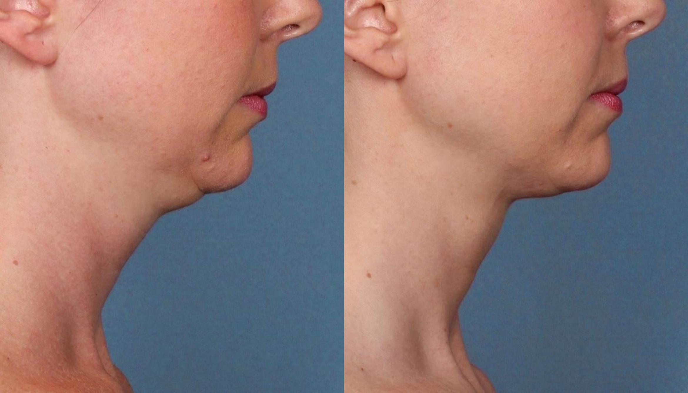 Before & After Double Chin Reduction Case 517 View #1 View in Shreveport, LA