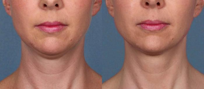 Before & After Double Chin Reduction Case 517 View #2 View in Shreveport, LA