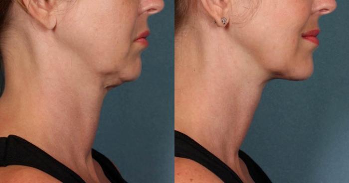 Before & After Double Chin Reduction Case 518 View #1 View in Shreveport, LA