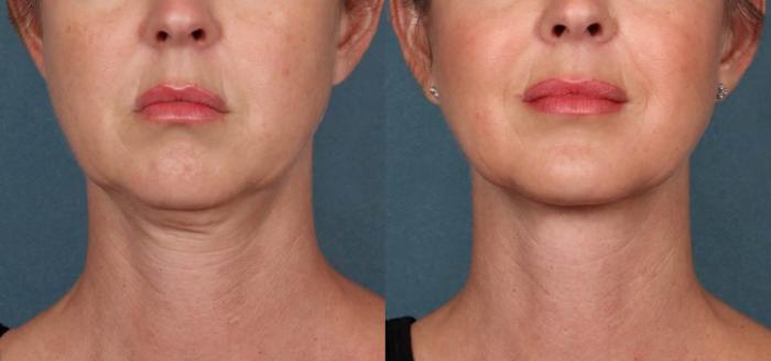 Before & After Double Chin Reduction Case 518 View #2 View in Shreveport, LA