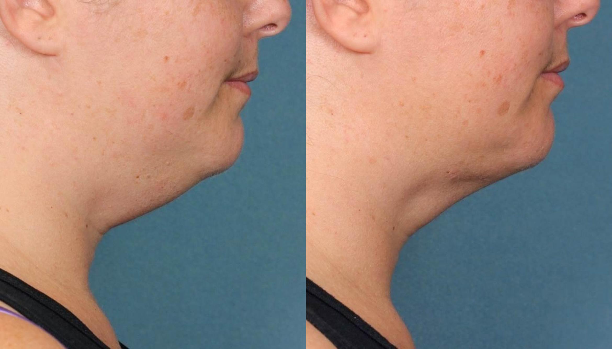 Before & After Double Chin Reduction Case 519 View #1 View in Shreveport, LA
