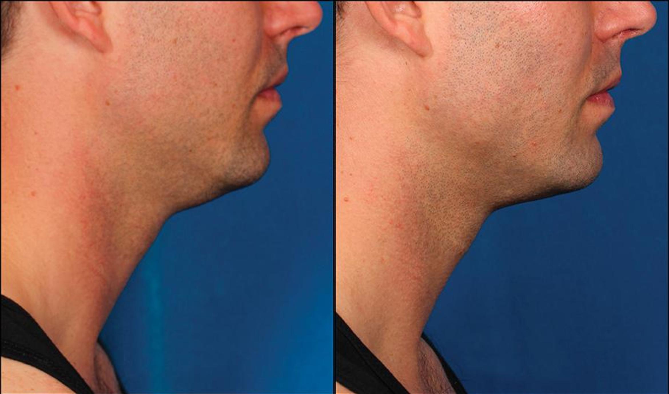 Before & After Double Chin Reduction Case 520 View #1 View in Shreveport, LA