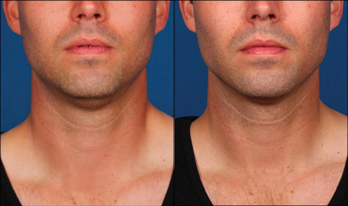 Before & After Double Chin Reduction Case 520 View #2 View in Shreveport, LA