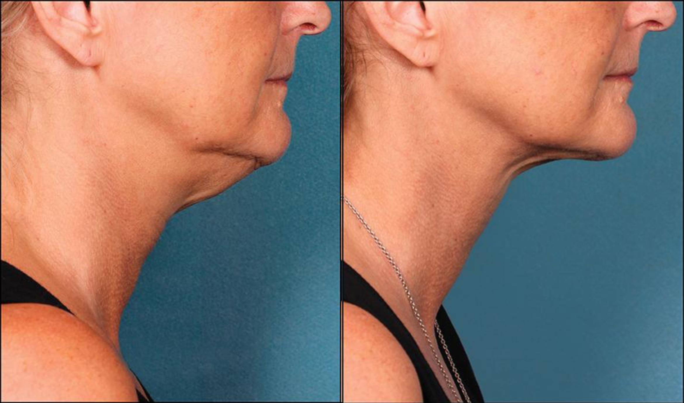Before & After Double Chin Reduction Case 521 View #1 View in Shreveport, LA
