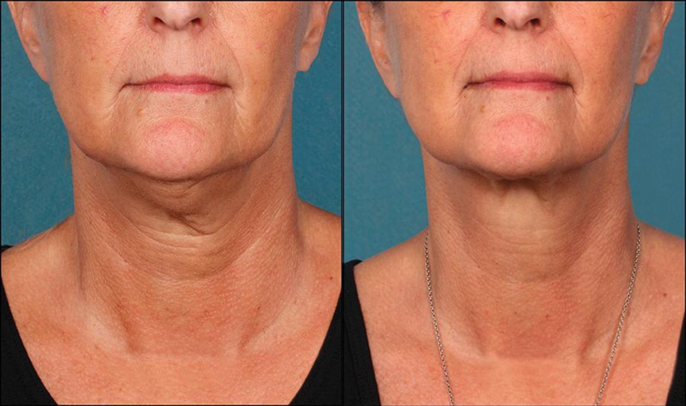 Before & After Double Chin Reduction Case 521 View #2 View in Shreveport, LA