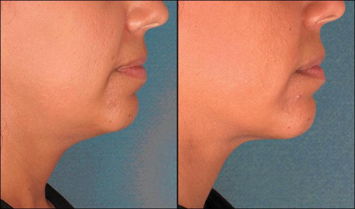 Before & After Double Chin Reduction Case 522 View #1 View in Shreveport, LA