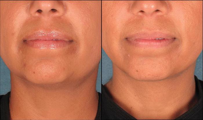 Before & After Double Chin Reduction Case 522 View #2 View in Shreveport, LA