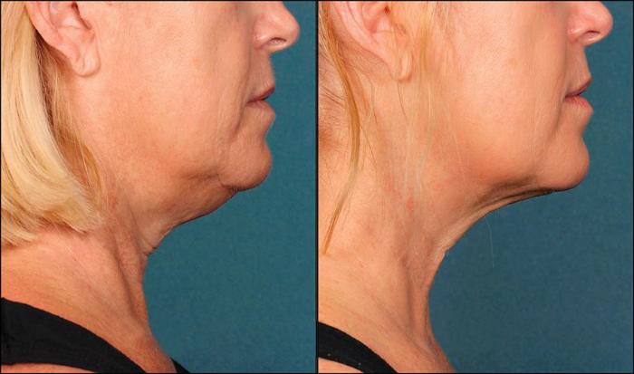 Before & After Double Chin Reduction Case 523 View #1 View in Shreveport, LA