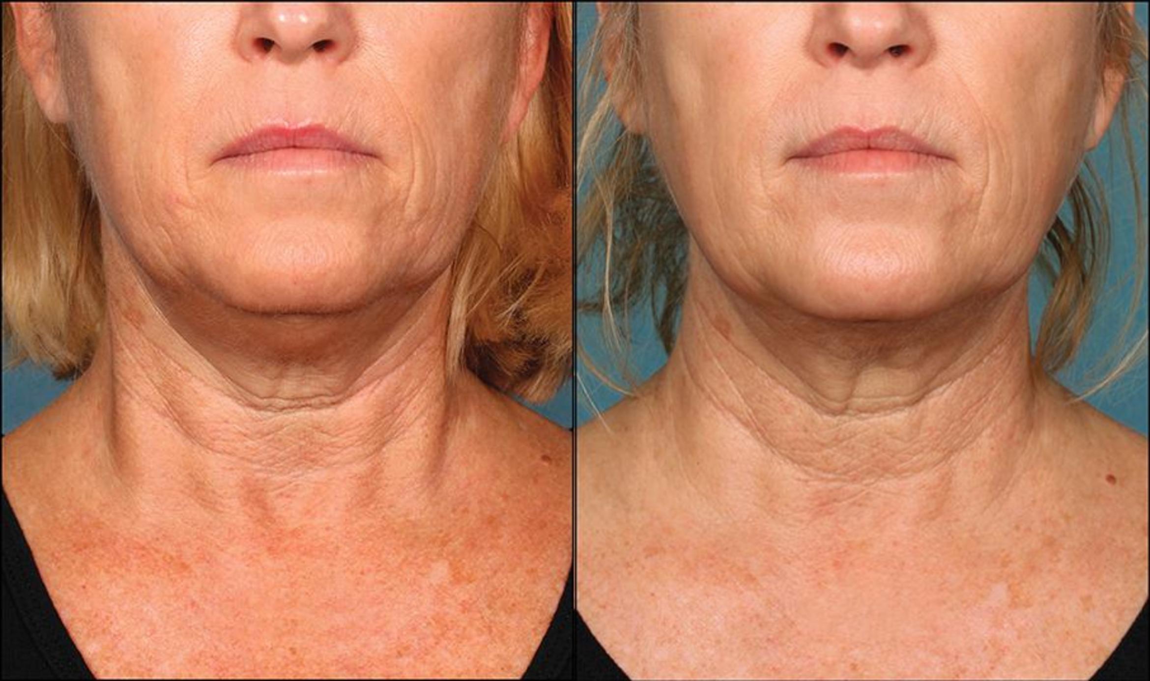 Before & After Double Chin Reduction Case 523 View #2 View in Shreveport, LA