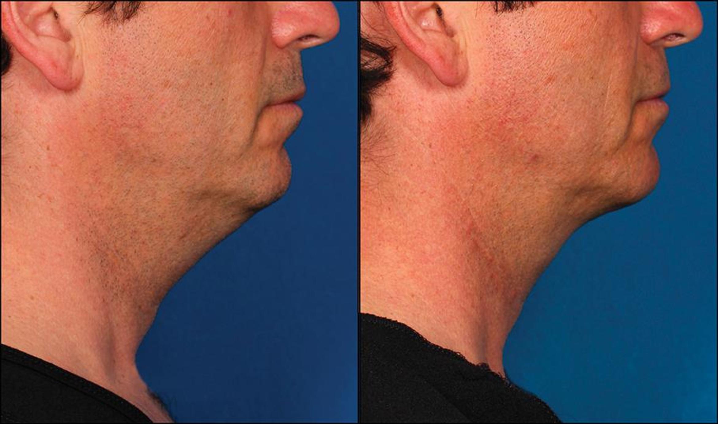Before & After Double Chin Reduction Case 524 View #1 View in Shreveport, LA