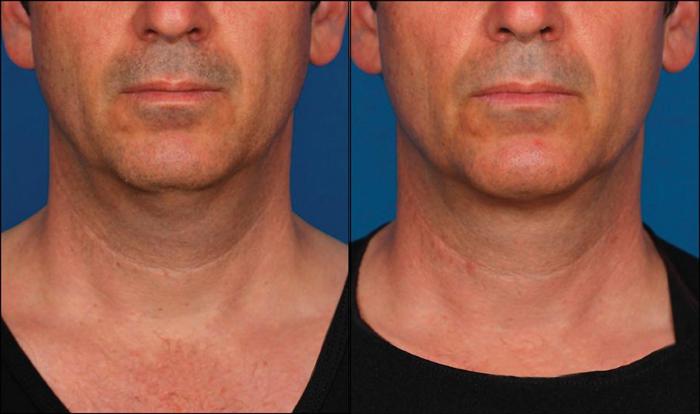 Before & After Double Chin Reduction Case 524 View #2 View in Shreveport, LA