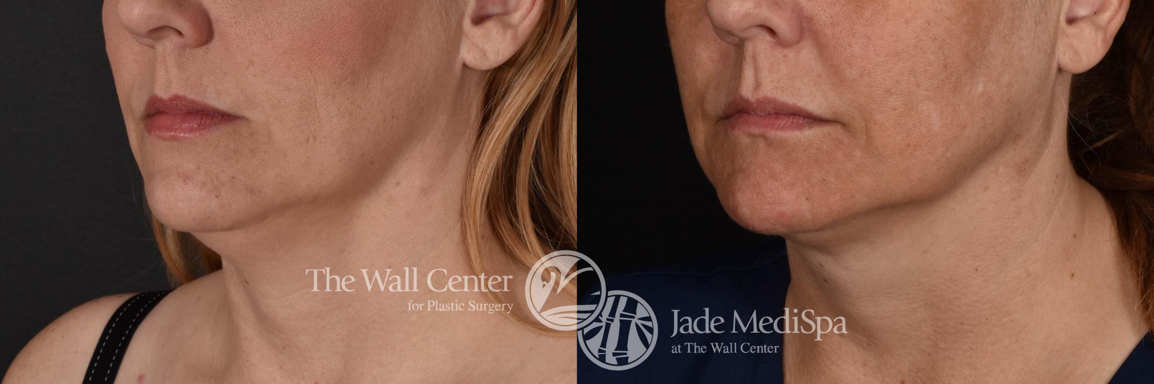 CoolSculpting Left Oblique Photo, Shreveport, Louisiana, Jade Medispa, The Wall Center, Case 572