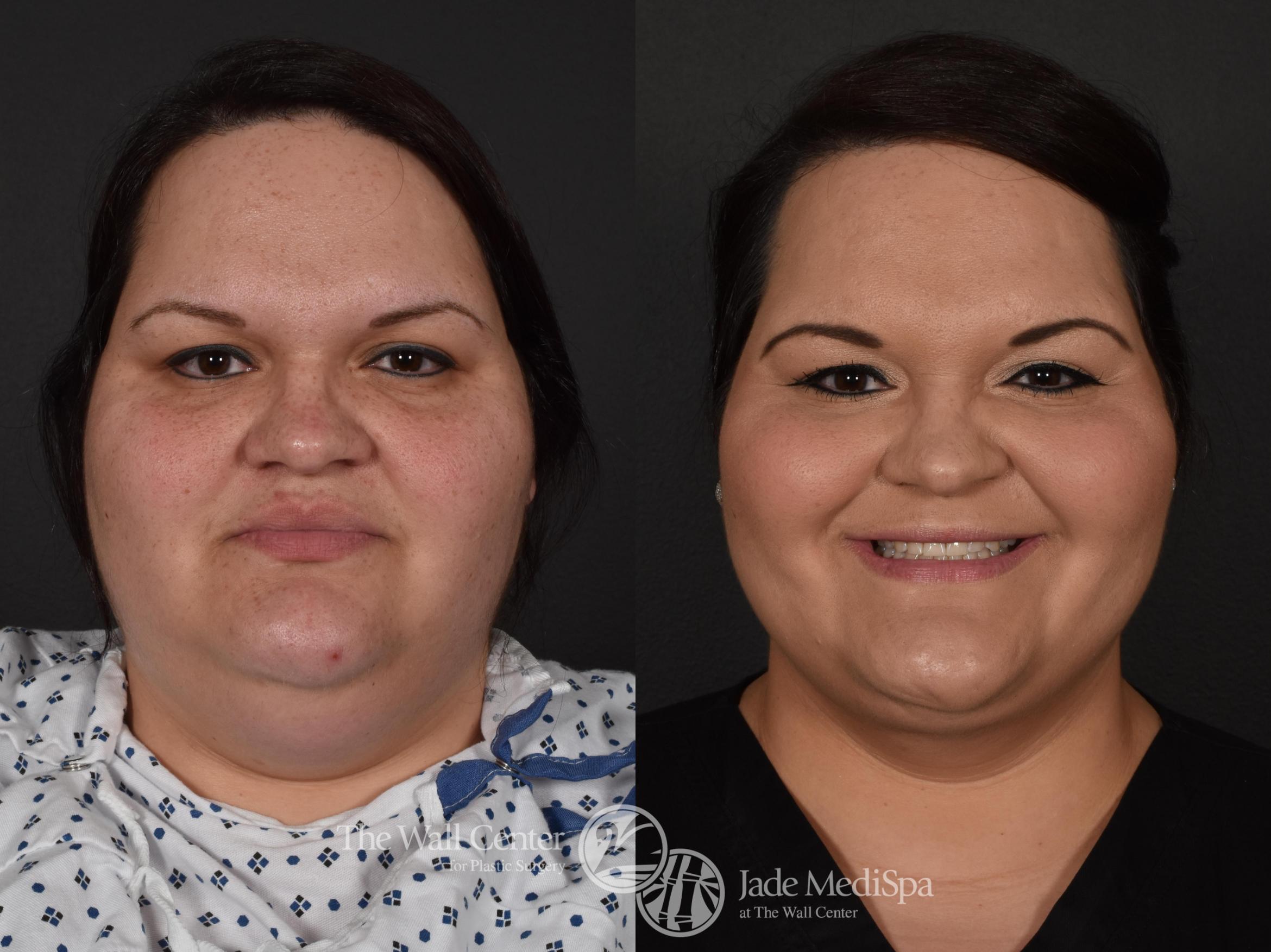 Before & After Double Chin Reduction Case 576 View #1 View in Shreveport, LA