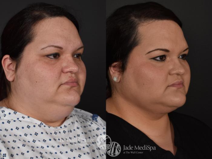 Before & After Double Chin Reduction Case 576 View #2 View in Shreveport, LA
