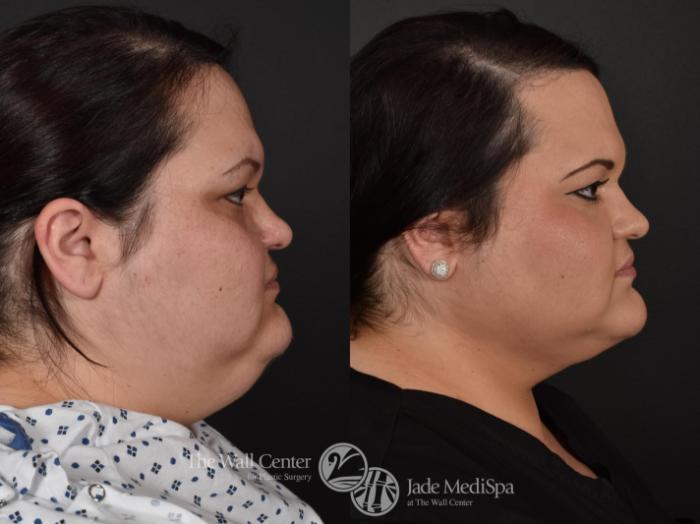Before & After Double Chin Reduction Case 576 View #3 View in Shreveport, LA