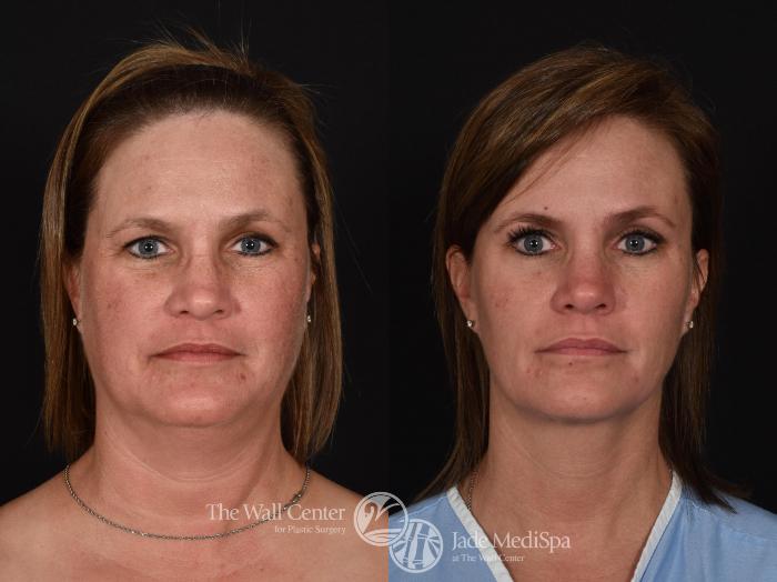 Before & After Double Chin Reduction Case 725 VIEW #1 View in Shreveport, LA