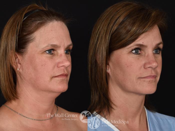 Before & After Double Chin Reduction Case 725 VIEW #2 View in Shreveport, LA