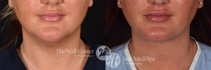 Double Chin Reduction Front Photo, Shreveport, Louisiana, The Wall Center for Plastic Surgery, Case 909