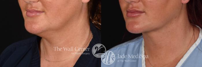 Double Chin Reduction Left Oblique Photo, Shreveport, Louisiana, The Wall Center for Plastic Surgery, Case 909