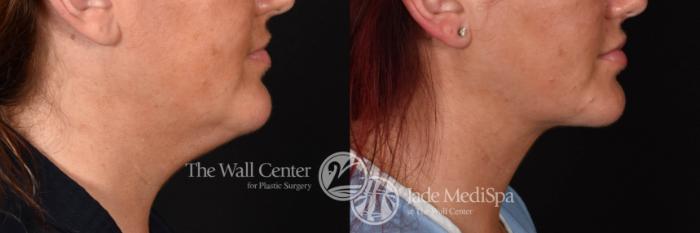 Double Chin Reduction Right Side Photo, Shreveport, Louisiana, The Wall Center for Plastic Surgery, Case 909