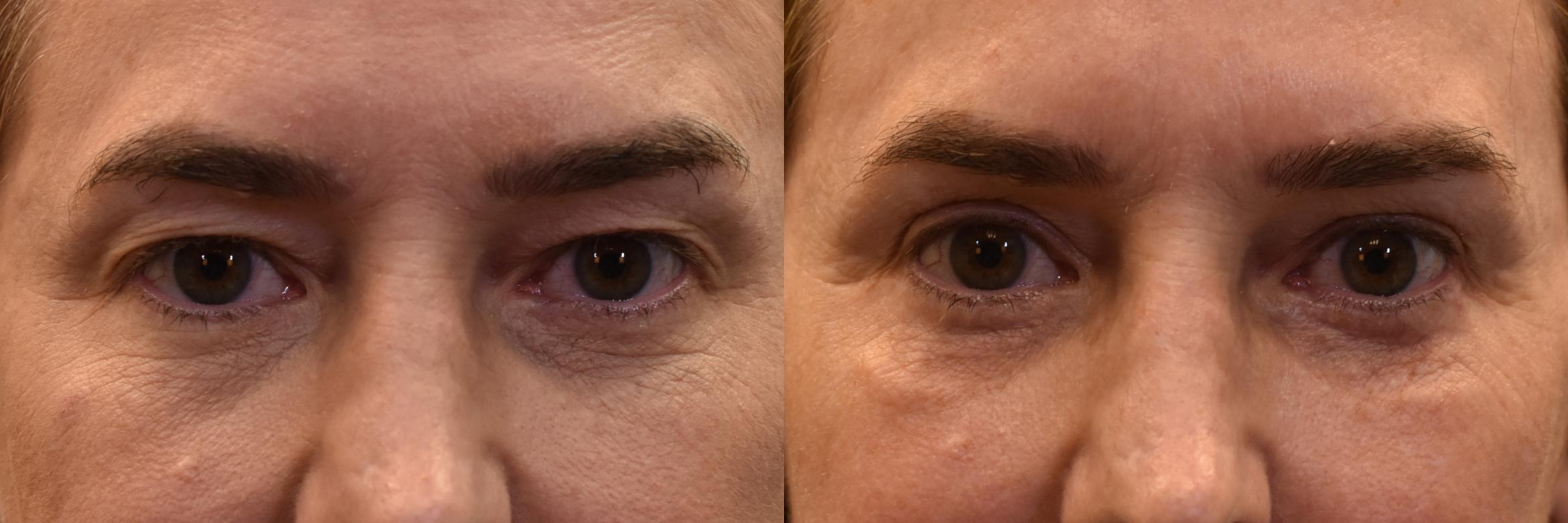 Before & After Eyelid Surgery Case 1112 Front View in Shreveport, LA