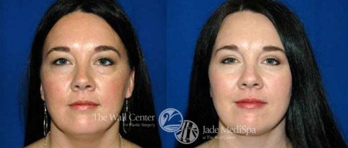 Before & After Eyelid Surgery Case 183 View #1 View in Shreveport, LA
