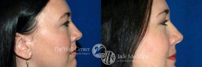 Before & After Eyelid Surgery Case 183 View #2 View in Shreveport, LA