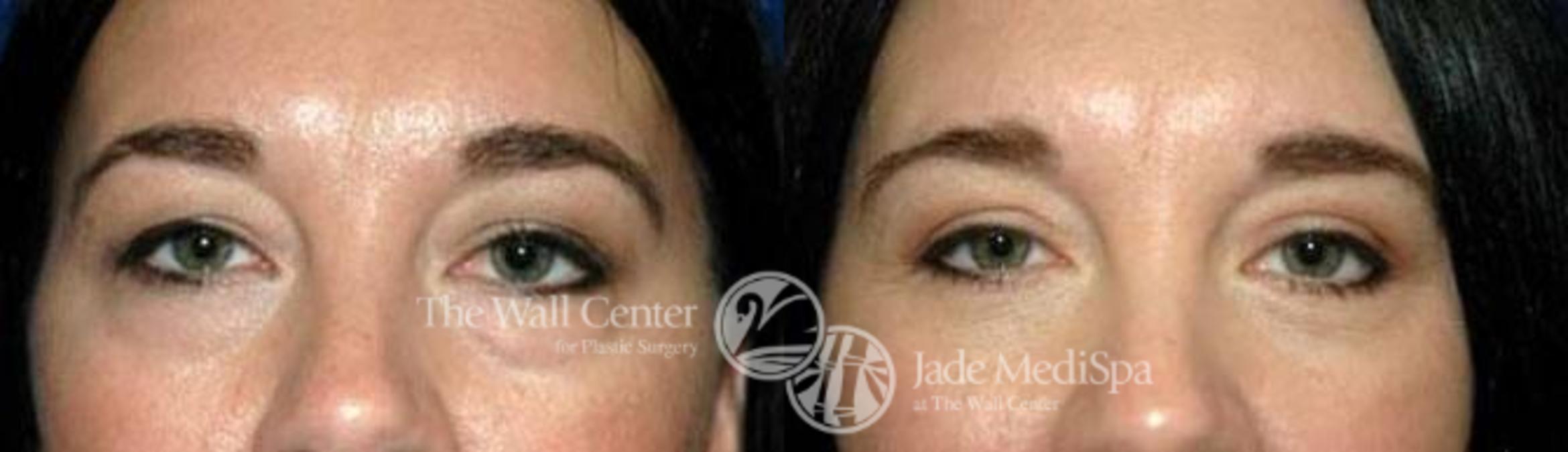 Before & After Eyelid Surgery Case 183 View #3 View in Shreveport, LA