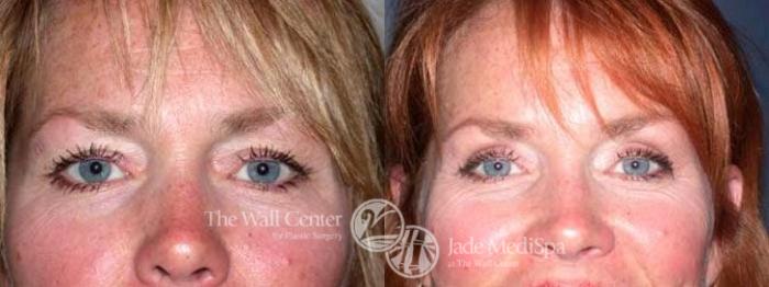 Before & After Eyelid Surgery Case 184 View #1 View in Shreveport, LA