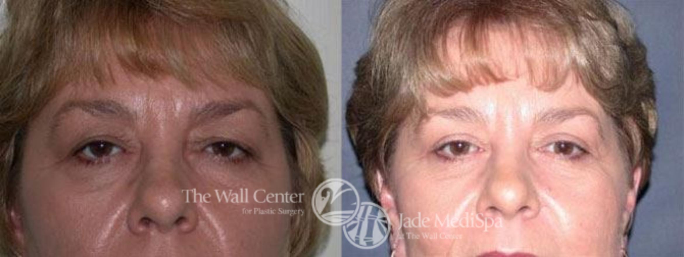 Before & After Eyelid Surgery Case 185 View #2 View in Shreveport, LA