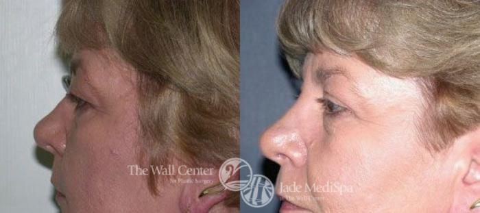 Before & After Eyelid Surgery Case 185 View #3 View in Shreveport, LA