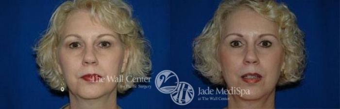 Before & After Eyelid Surgery Case 186 View #1 View in Shreveport, LA